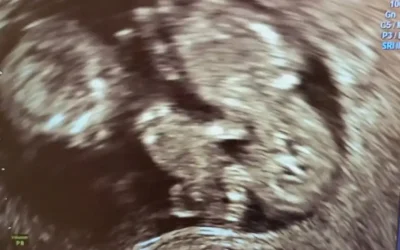 Échographie d&rsquo;une Grossesse Gémellaire